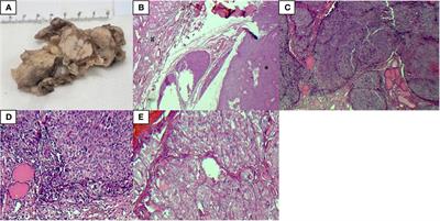 Coexistence of intrathyroid thymic carcinoma and papillary thyroid carcinoma: a case report and literature review